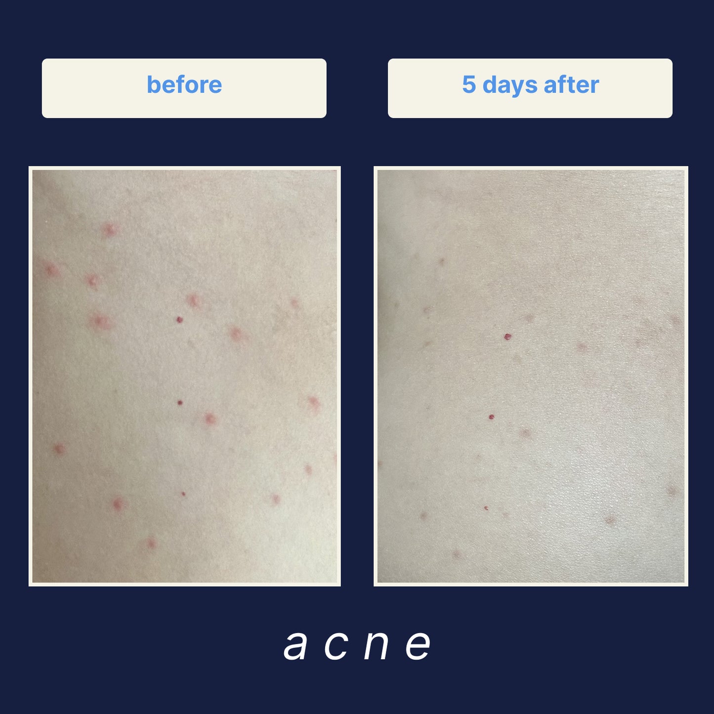 Skeen Hypochlorous Acid Facial Spray